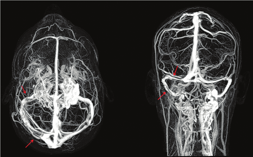 What-is-the-difference-between-a-contrast-and-Non contrast-MRI, magnetic-resonance-venography-demonstrates-partial-venous-thrombosis-of-the-right