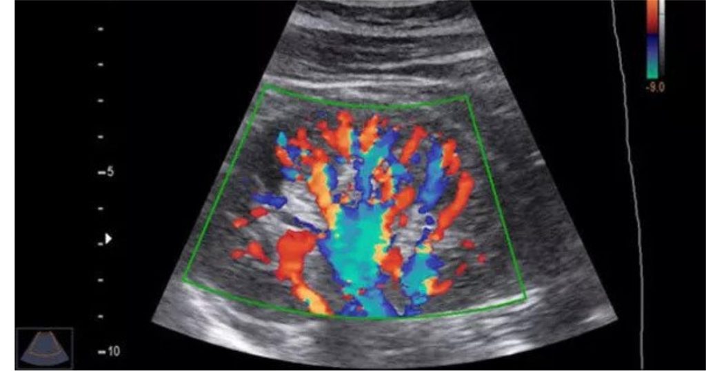 how much water to drink before sonography - color doppler 