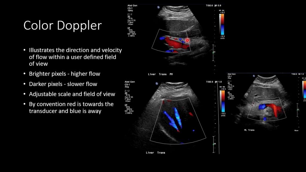 how sonography is done-doppler ultrasound