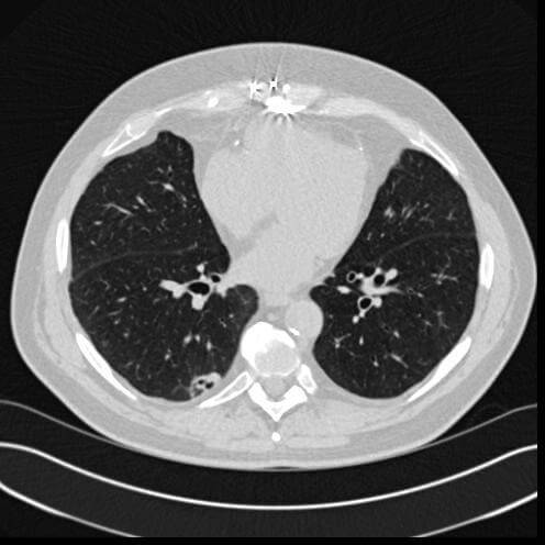 how to read a CT scan, lung CT scan