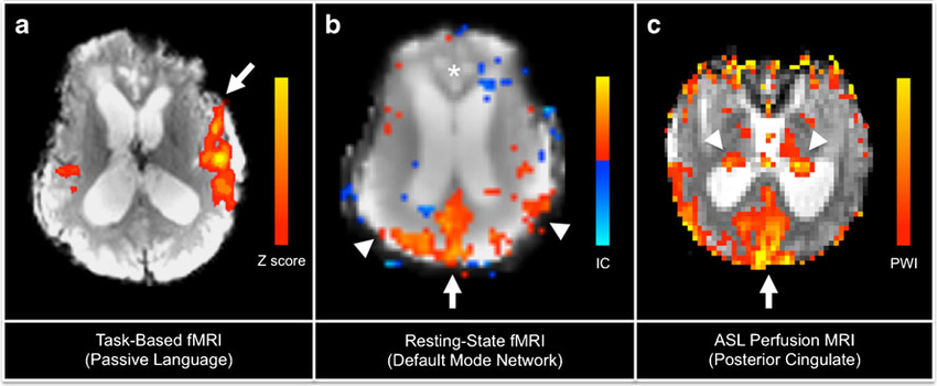 is-MRI-scan-safe-procedure, fMRI-and-arterial-spin-labeling-ASL