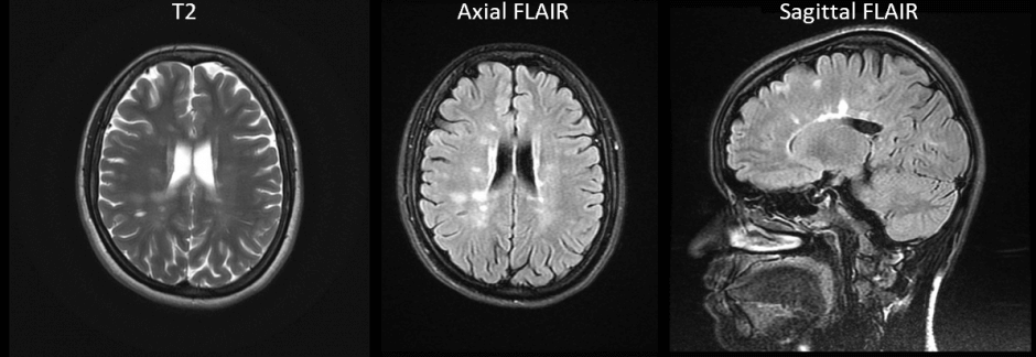 what-are-the-different-types-of-MRI-scan, FLAIR