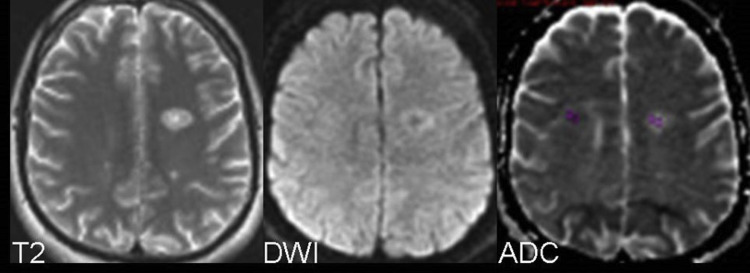 what-is-the-side-effect-of-MRI-scan, DWI and ADC