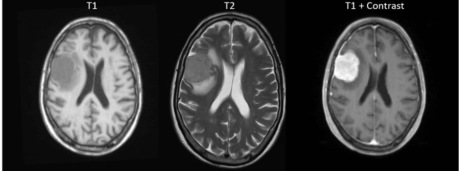 why-is-MRI-scan-done,t1-and-t2